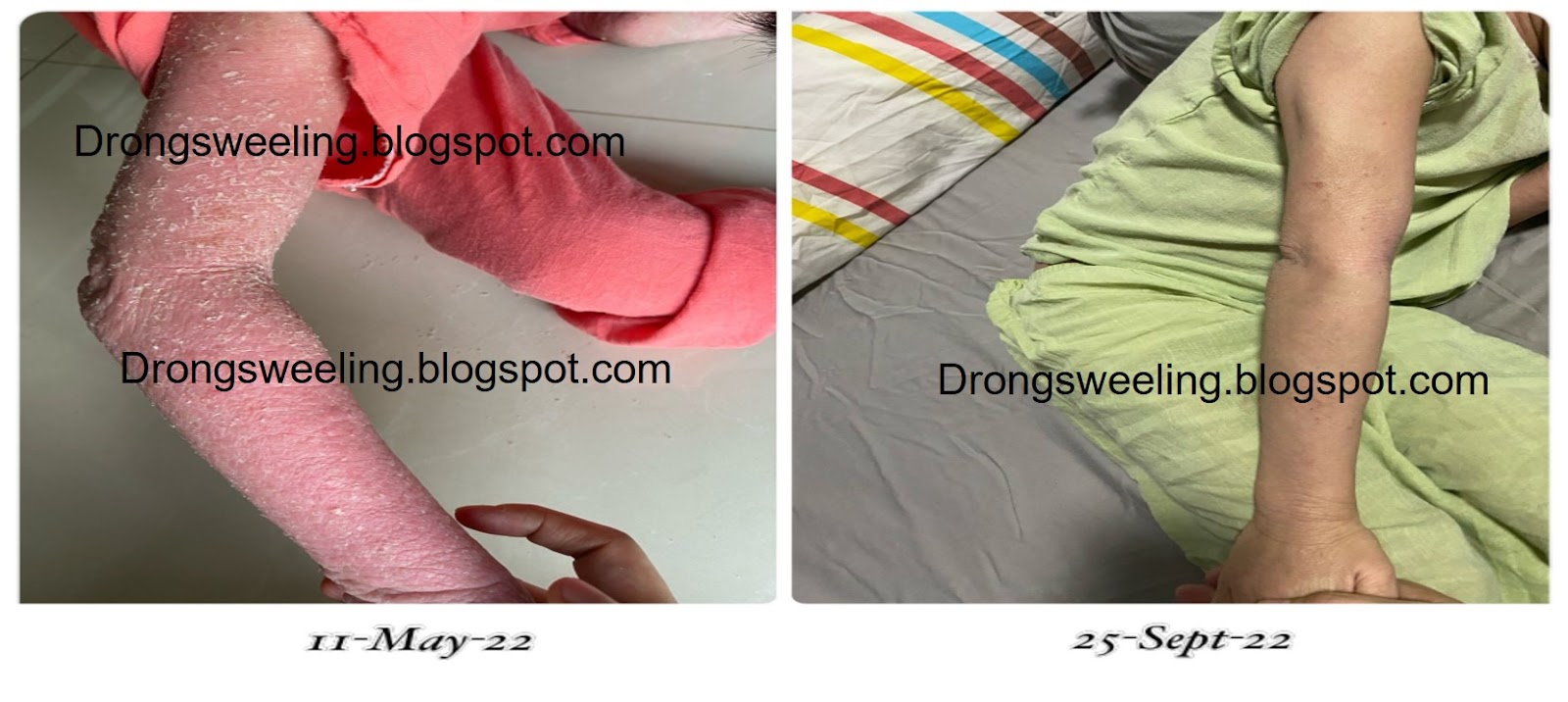 Child's eczema on the arm — before and after TCM treatment