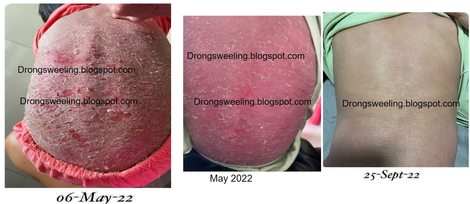 Child's eczema on the body — progression over the course of TCM treatment