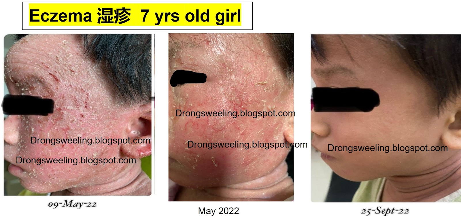Child's facial eczema — progression over the course of TCM treatment