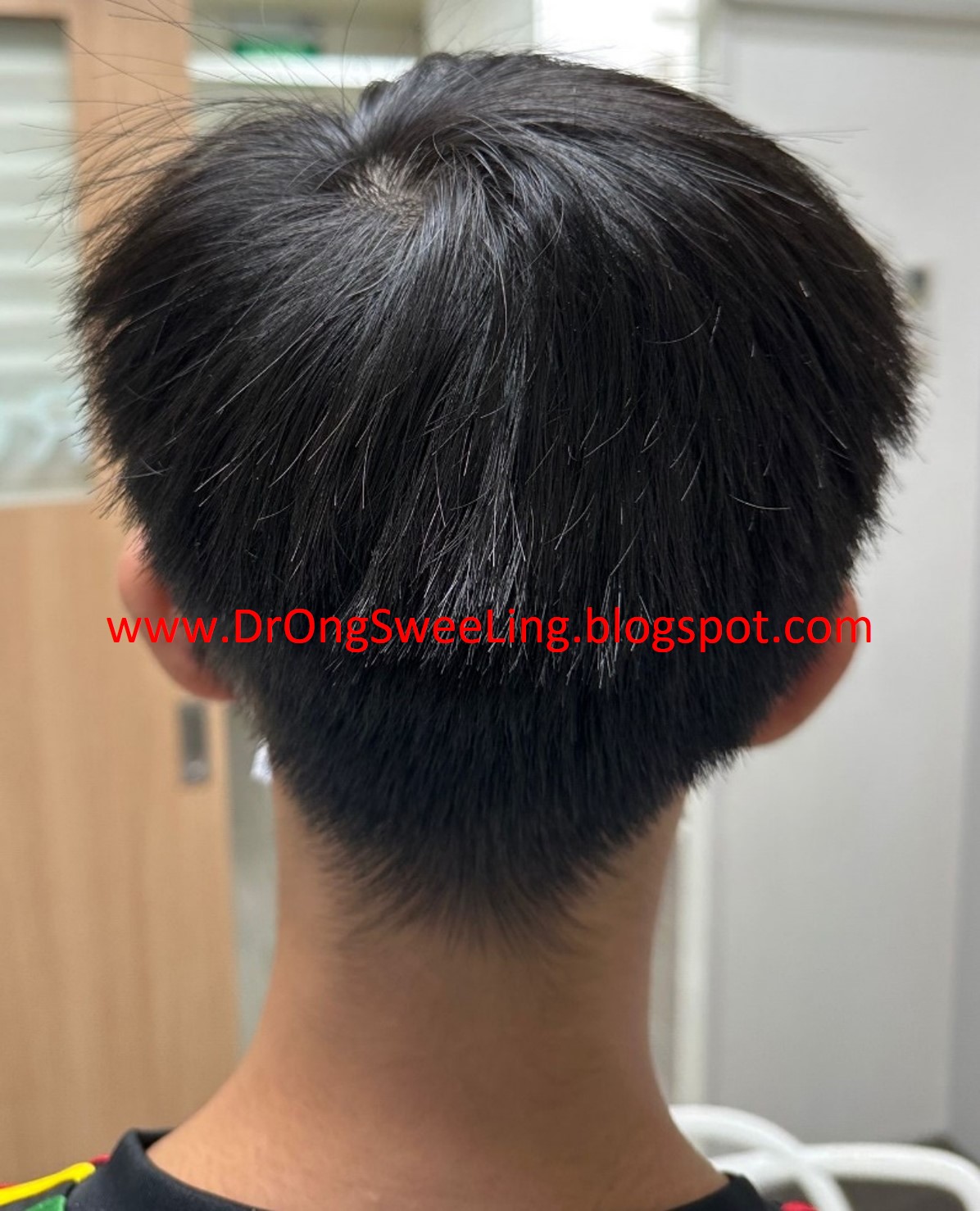 Hair fully regrown after 4–5 months of TCM treatment