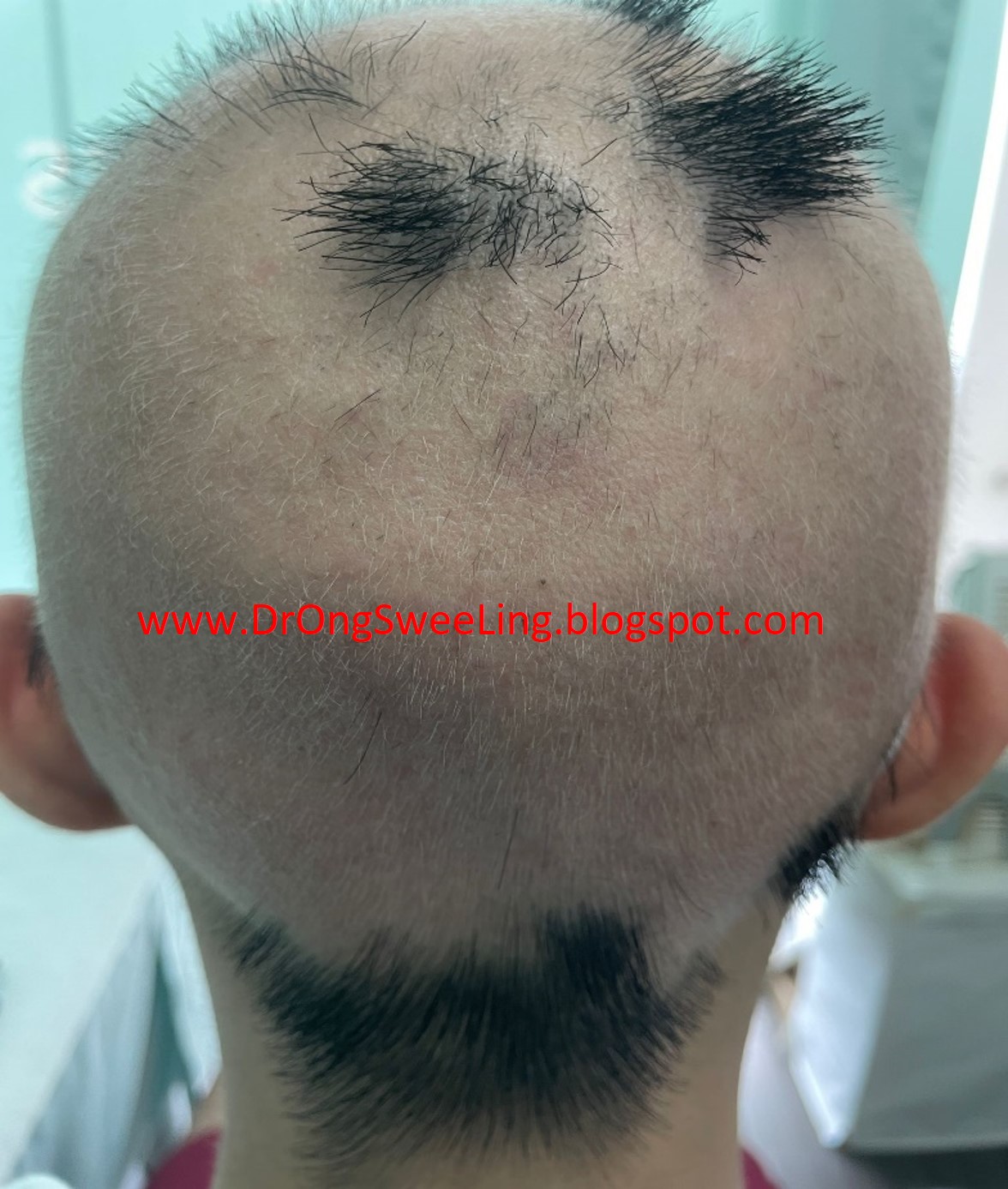 Severe alopecia, back view, before TCM treatment