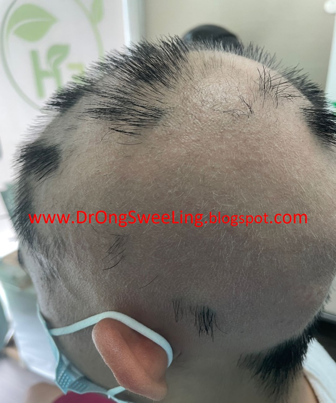 Severe alopecia in a 16-year-old student, side view, before TCM treatment