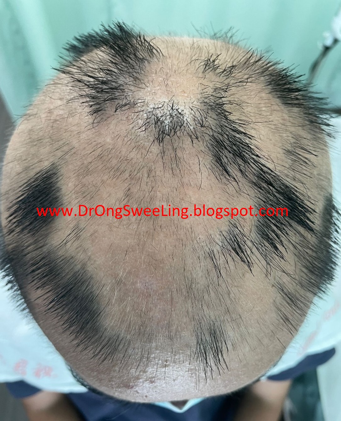 Severe alopecia, top view, before TCM treatment