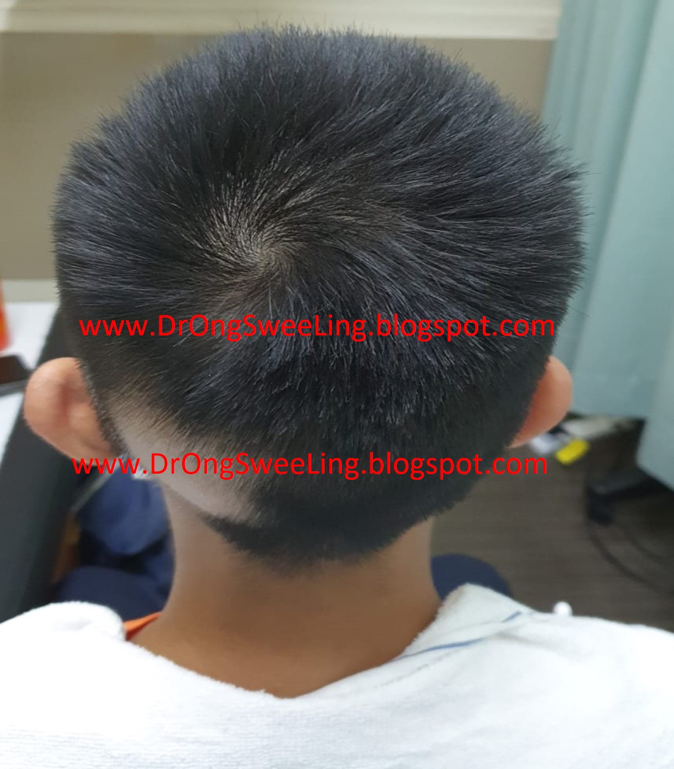 Hair almost fully regrown after months of TCM treatment