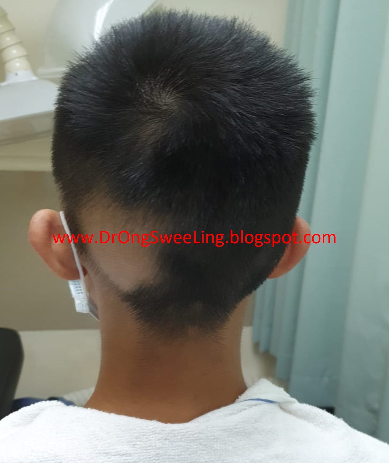 Hair growing back during TCM scalp treatment
