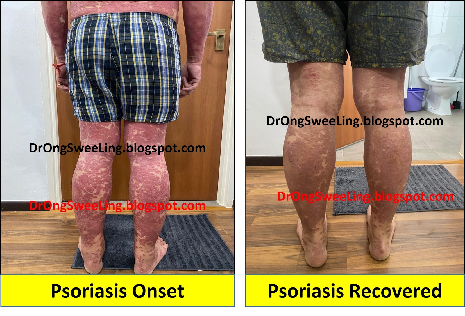 Psoriasis on the legs, back view — before and after TCM treatment