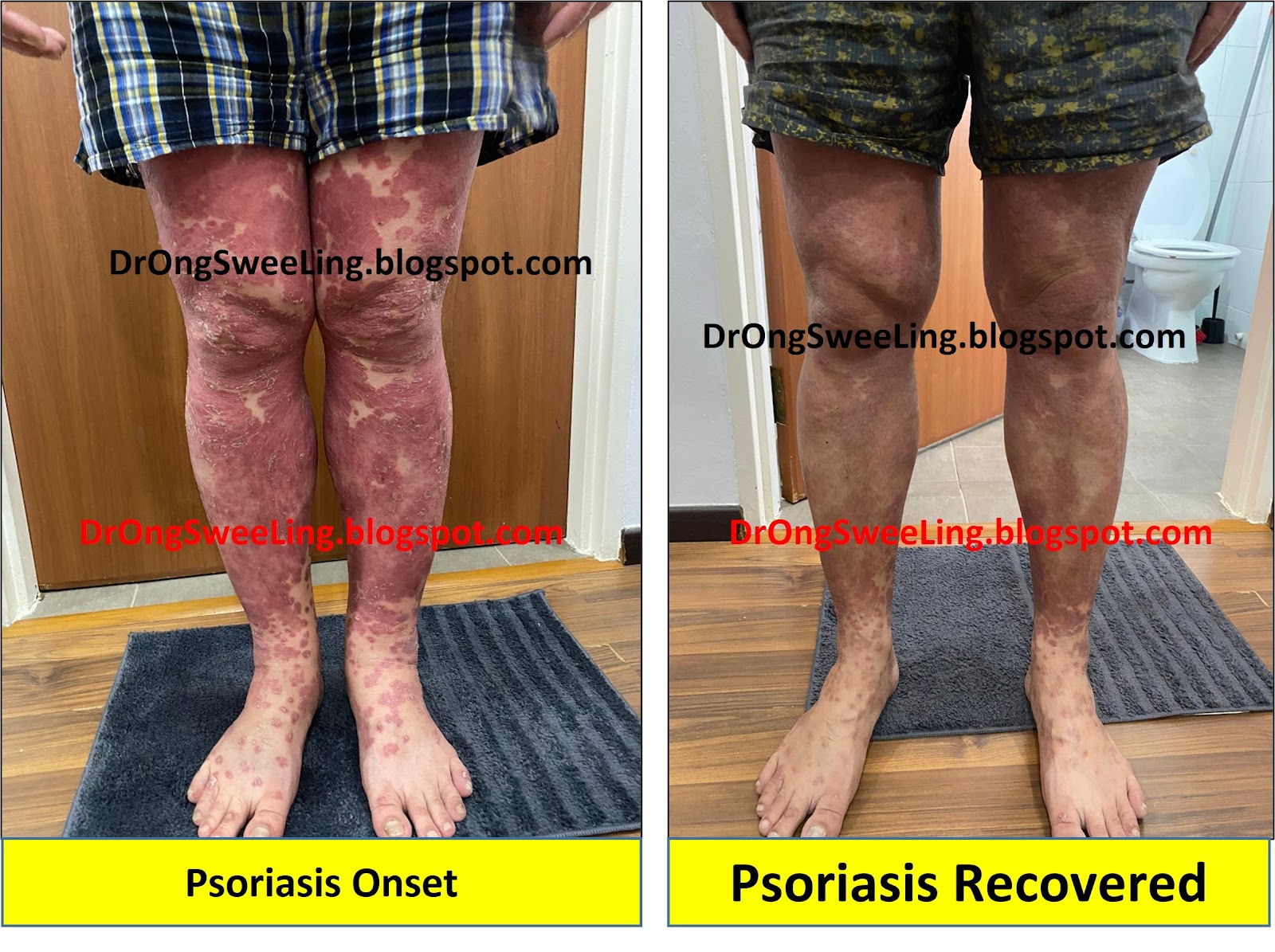 Psoriasis on the legs — before and after TCM treatment