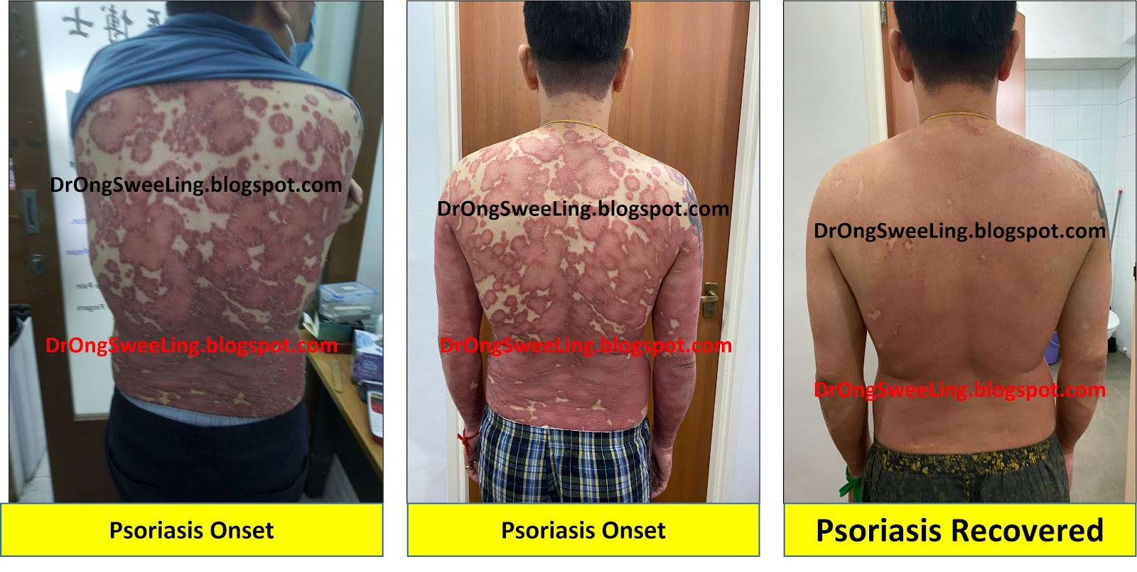 Psoriasis on the torso, back view — progression over the course of TCM treatment