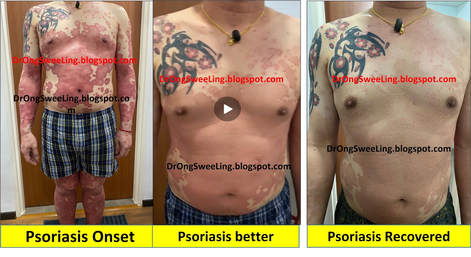 Psoriasis on the torso, front view — progression over the course of TCM treatment