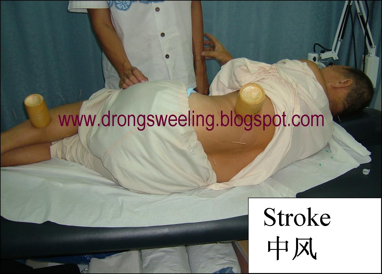Stroke patient receiving acupuncture and cupping treatment at Eastern Healing TCM Clinic