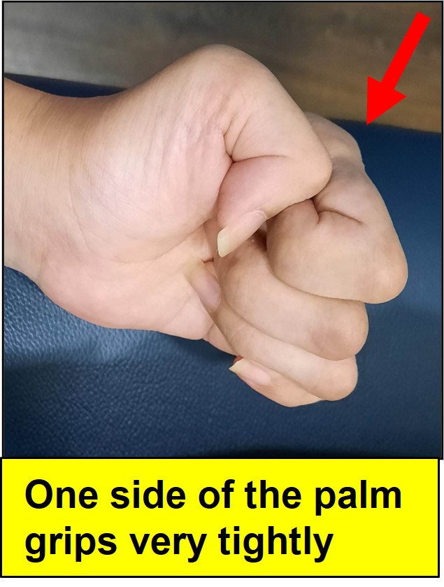 Stroke patient's affected hand regaining grip during recovery