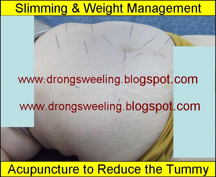 TCM weight management treatment using cupping on the abdomen at Eastern Healing TCM Clinic