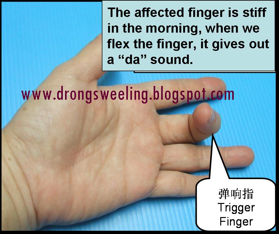 Trigger finger locked in a bent position before TCM treatment